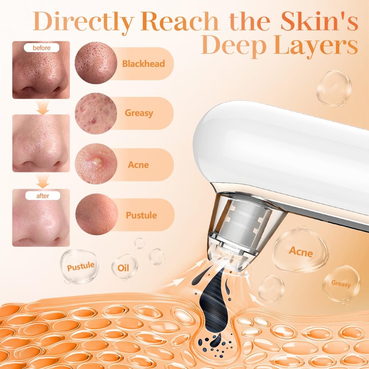 Yccu Blackhead Remover Vacuum - Image 3