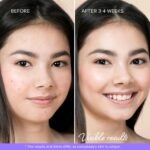 MAREE Acne Patches Set - Image 5